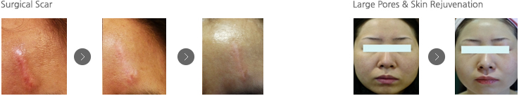 상처수술 개선 | 모공&피부 회복 개선