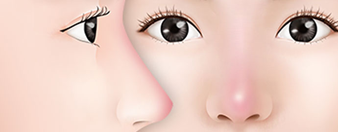 nose revision surgery