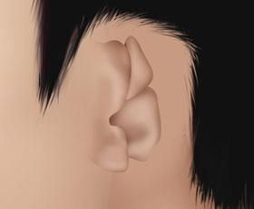 microtia