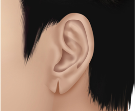 splited earlobe