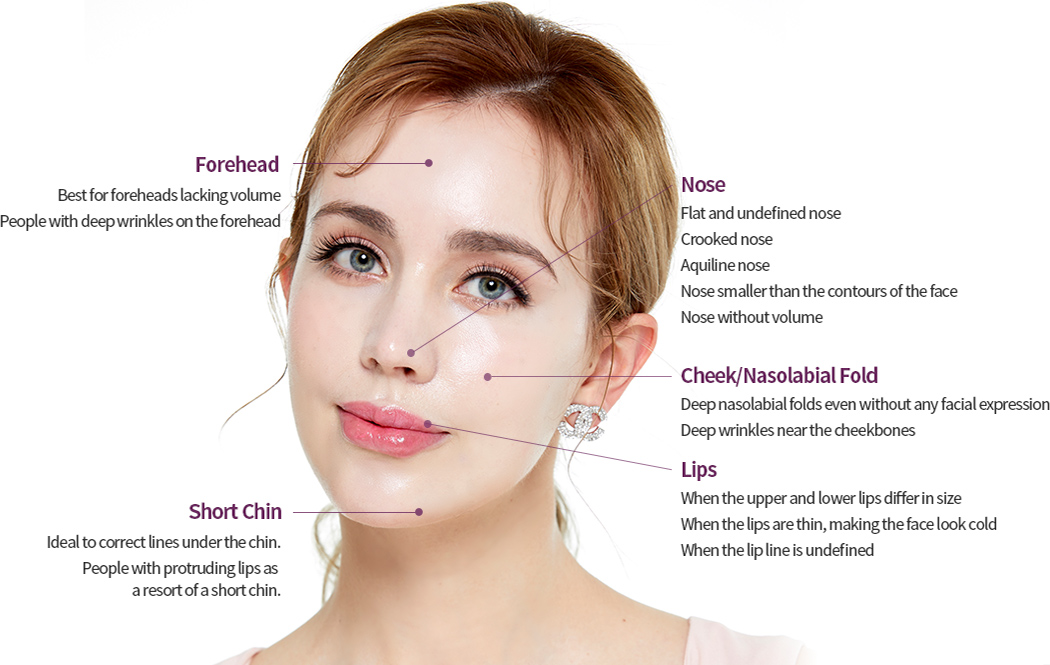 Areas to Inject Fillers