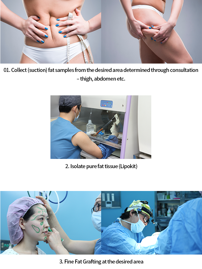 1.원하는부위 지방채취, 2.순수지방조직분리, 3.원하는 부위 미세하게 지방이식