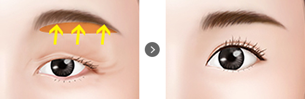 Sub-brow Lifting