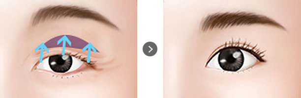 Sub-brow Lifting