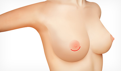 Incision along the edge of the areola