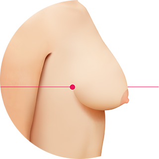 Breast Augmentation Surgery For Saggy Breasts? – Eunogo