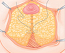 Areola Incision Method