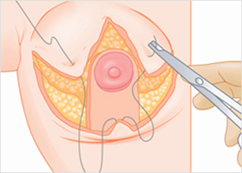 'Anchor Incision