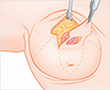 Vertical Incision Method