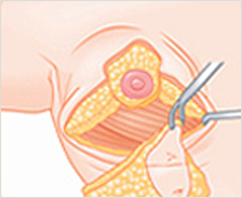 Vertical Incision Method