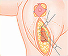 Vertical Incision Method