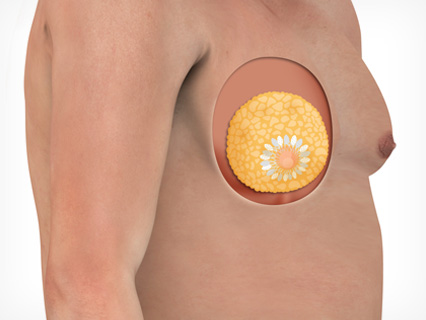 Fat breast material (yellow) causes gynecomastia