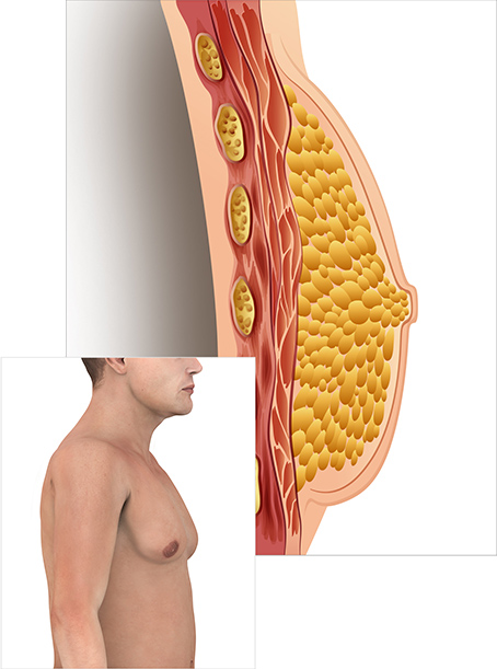 Cross-section of male with gynecomastia 