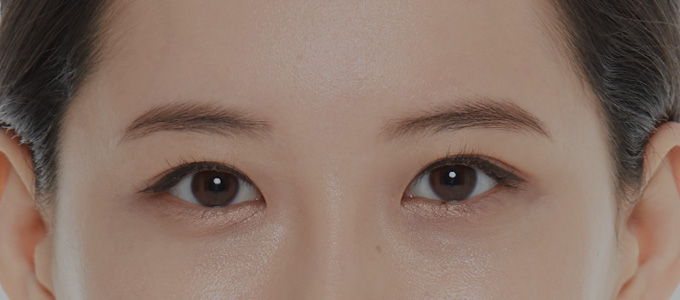 Ptosis Correction Surgery 