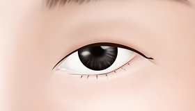A case of small horizontal length of eye