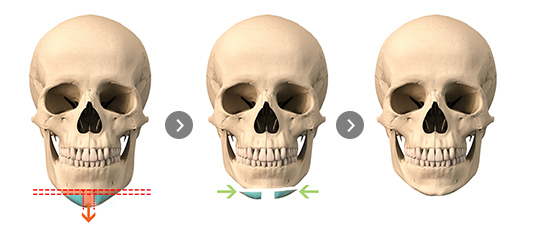 T-shaped osteotomy