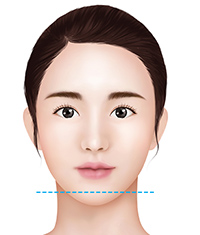 T-shaped osteotomy