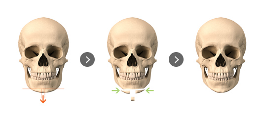 Mini V-Line – Front Jaw Reduction Surgery