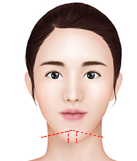 ㅅ-shaped osteotomy