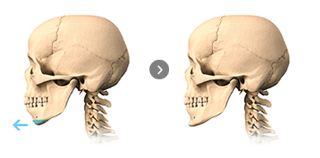 Chin Tip Advancement