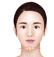 ㅅ-shaped osteotomy