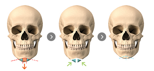 ㅅ-shaped osteotomy