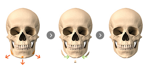 Wide Jaw – T-Osteotomy