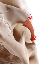 zygoma incision line2