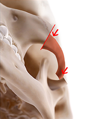 zygoma incision line3