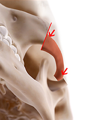 zygoma incision line4