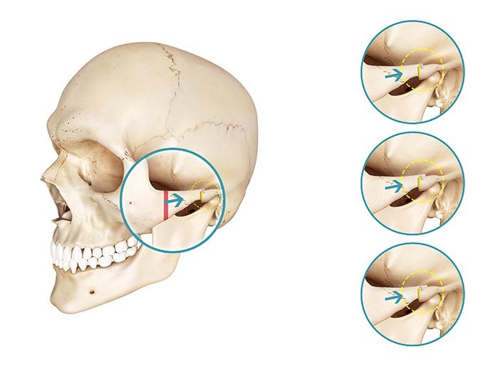 Movement amount of zygoma