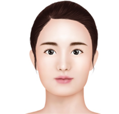 Mini V-Line – Front Chin Reduction
