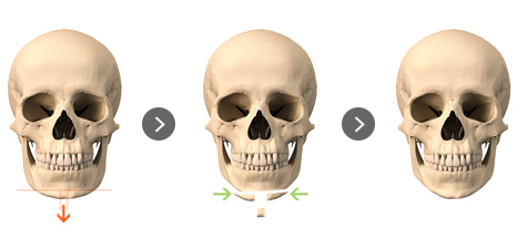 Mini V-Line – Front Chin Reduction