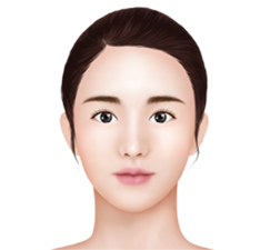 Mini V-Line – Front Chin Reduction