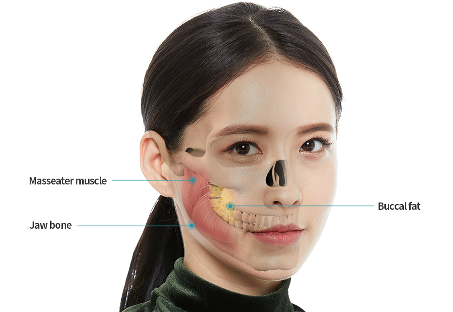 Muscle of mastication, Jaw bone, isthmus fat