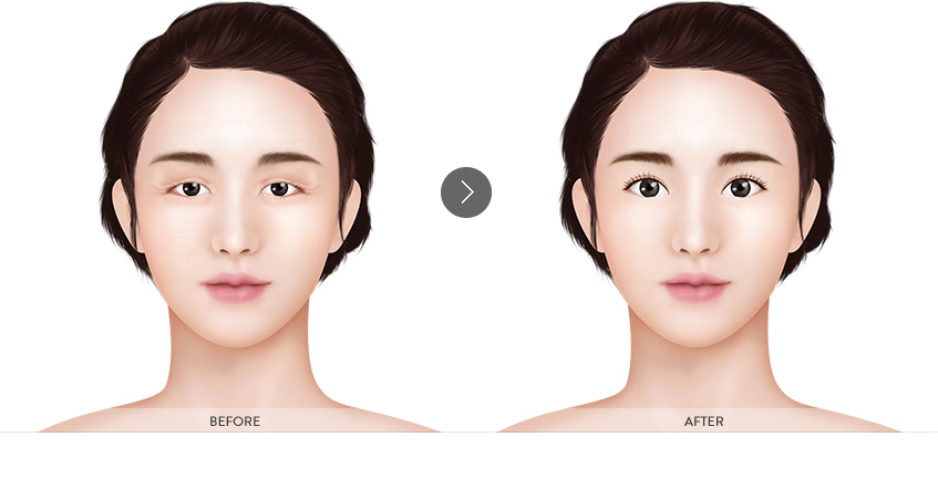 리프팅상안검 수술전후 이미지