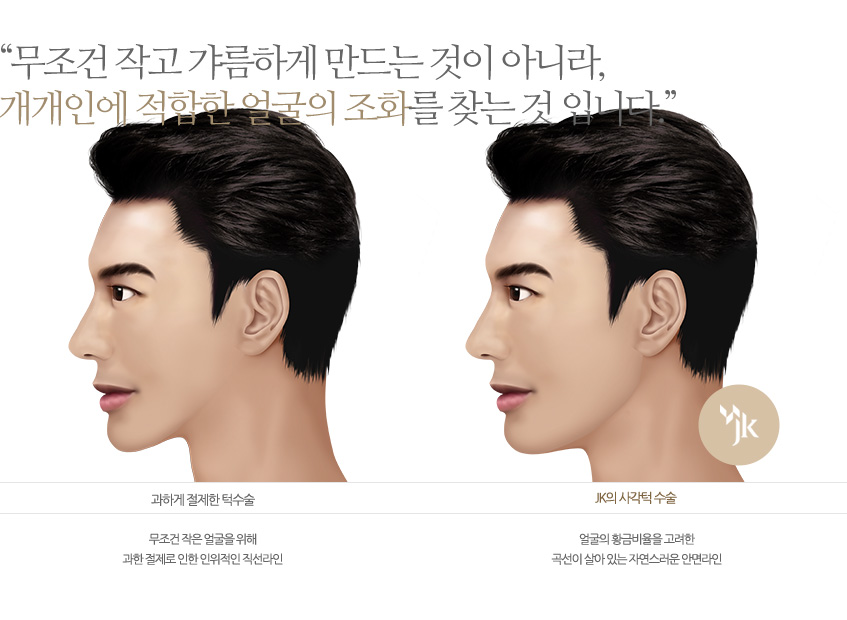 사각턱 수술정보