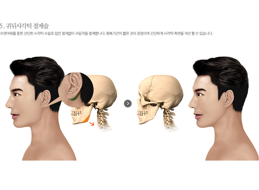 귀뒤 사각턱 절제술