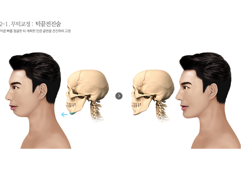 턱끝전진술