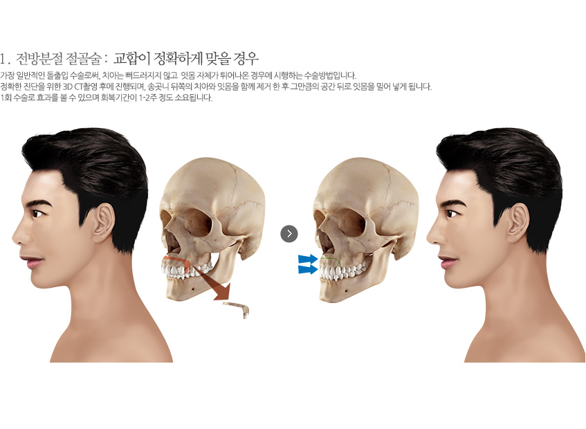 전방분절 절골술