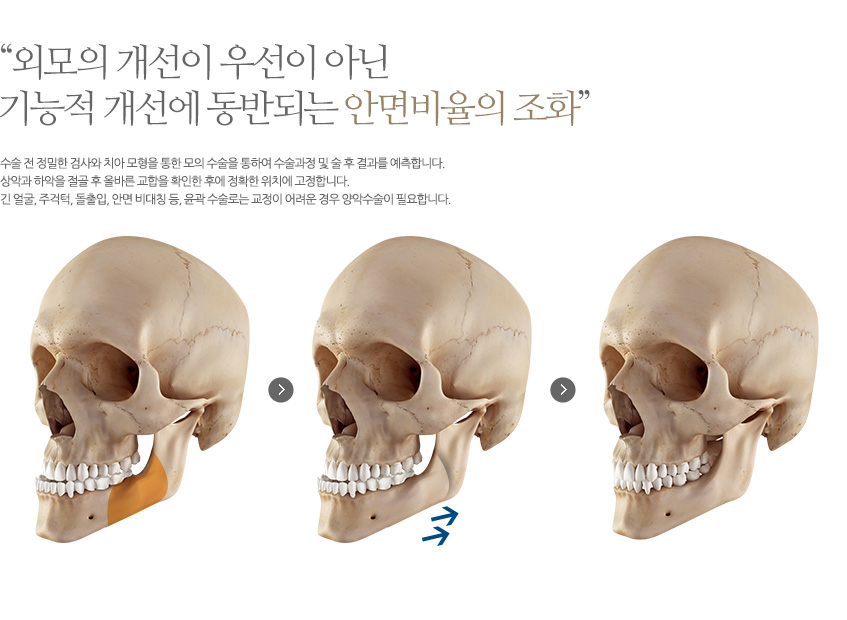 주걱턱 개선1