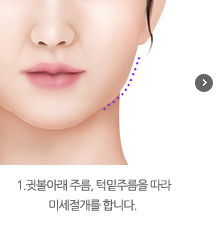 1.귓볼아래 주름, 턱밑주름을 따라 미세절개를 합니다.