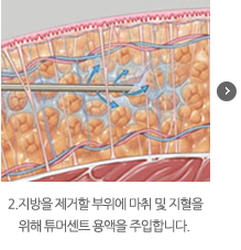 2.지방을 제거할 부위에 마취 및 지혈을 위해 튜머센트 용액을 주입합니다.