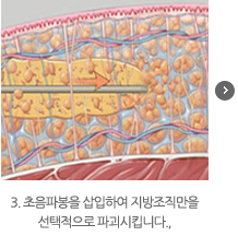 3. 초음파봉을 삽입하여 지방조직만을 선택적으로 파괴시킵니다.