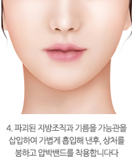 4. 파괴된 지방조직과 기름을 가능관을
삽입하여 가볍게 흡입해 낸후, 상처를 봉하고 압박밴드를 착용합니다