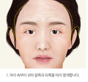 1. 머리 속부터 귀의 앞쪽과 뒤쪽을 따라 절개합니다.