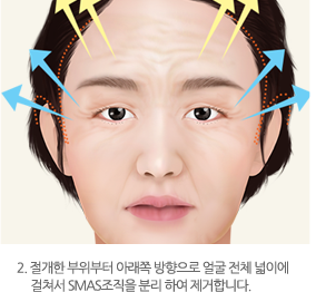 2. 절개한 부위부터 아래쪽 방향으로 얼굴 전체 넓이에 걸쳐서 SMAS조직을 분리 하여 제거합니다.