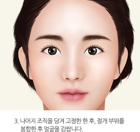 3. 나머지 조직을 당겨 고정한 한 후, 절개 부위를 봉합한 후 얼굴을 감쌉니다.