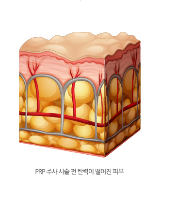 PRP주사 시술 전 탄력이 떨어진 피부