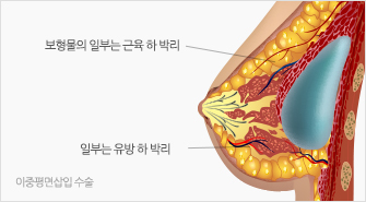 이중평면삽입 수술:보형물의 일부는 근육 하 박리, 일부는 유방 하 박리